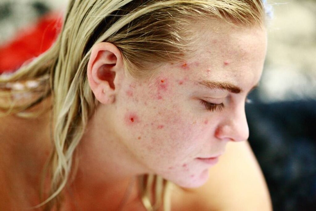 Acne Treatments
