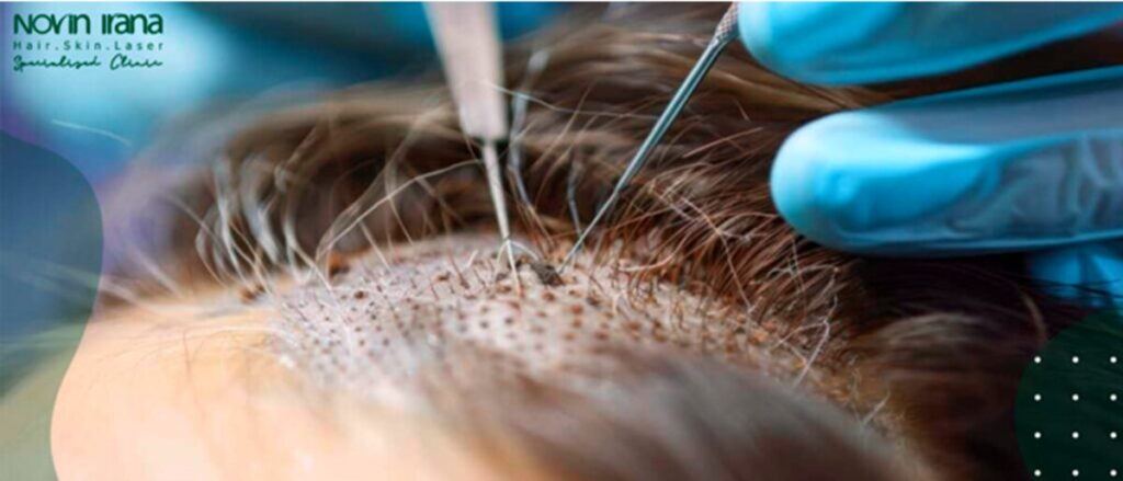 زراعة الشعر