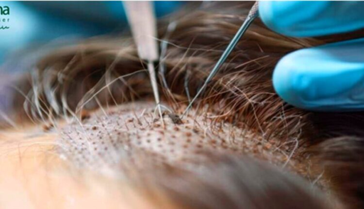 زراعة الشعر